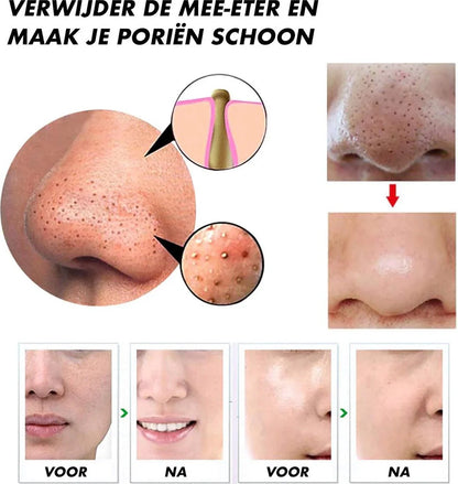 Electric Blackhead Remover