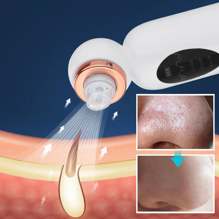 Blackhead Remover and Hydrodermabrasion Device