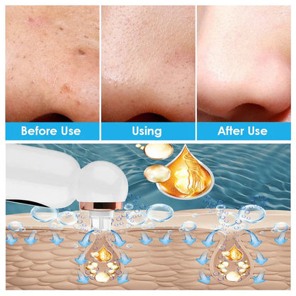 Blackhead Remover and Hydrodermabrasion Device
