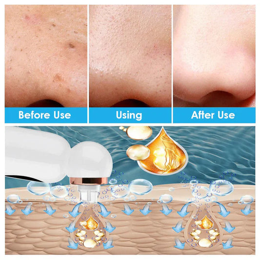 Blackhead Remover and Hydrodermabrasion Device