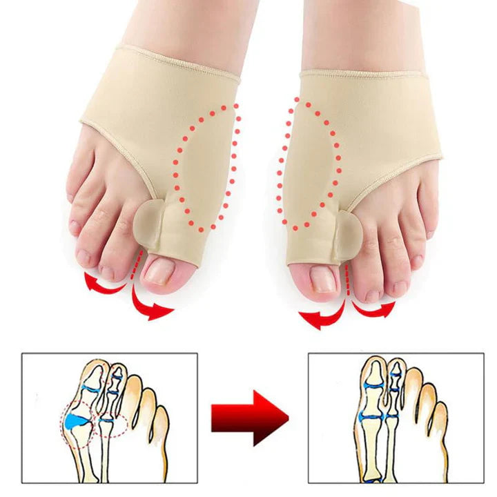 Hallux Valgus Correction Protection (1 Pair)