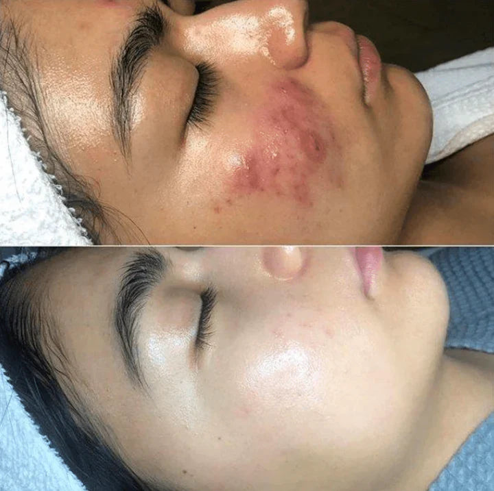 High-Frequency Skin Therapy Device